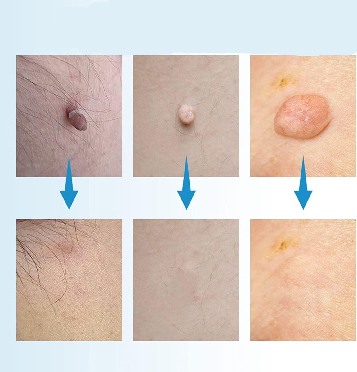 Skin stain remover for skin tags, age warts and birthmarks - painless use for neck, arms, back and legs 1