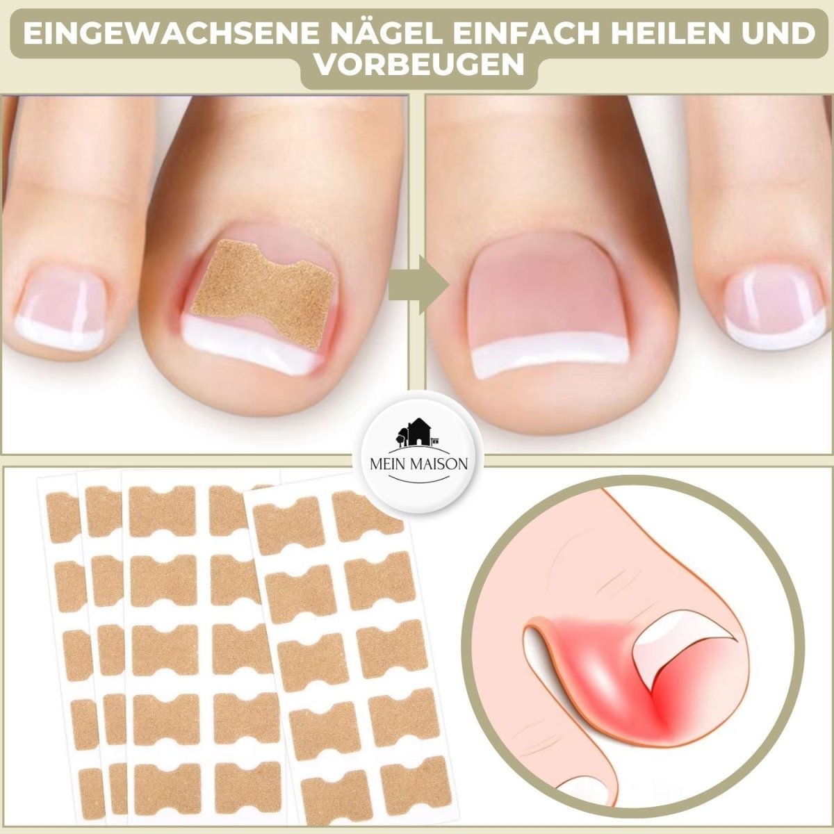 Fixerail - gentle nail correction against ingrown nails & pain 1