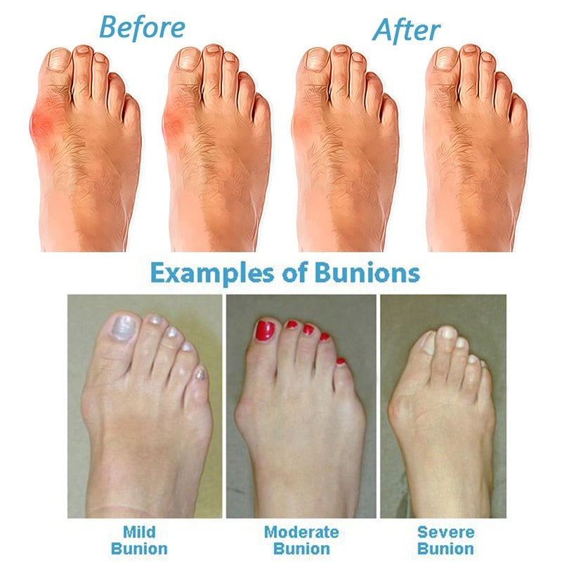 ORTHOSOLE SANDALS – Hallux Valgus sandals for pain-free walking