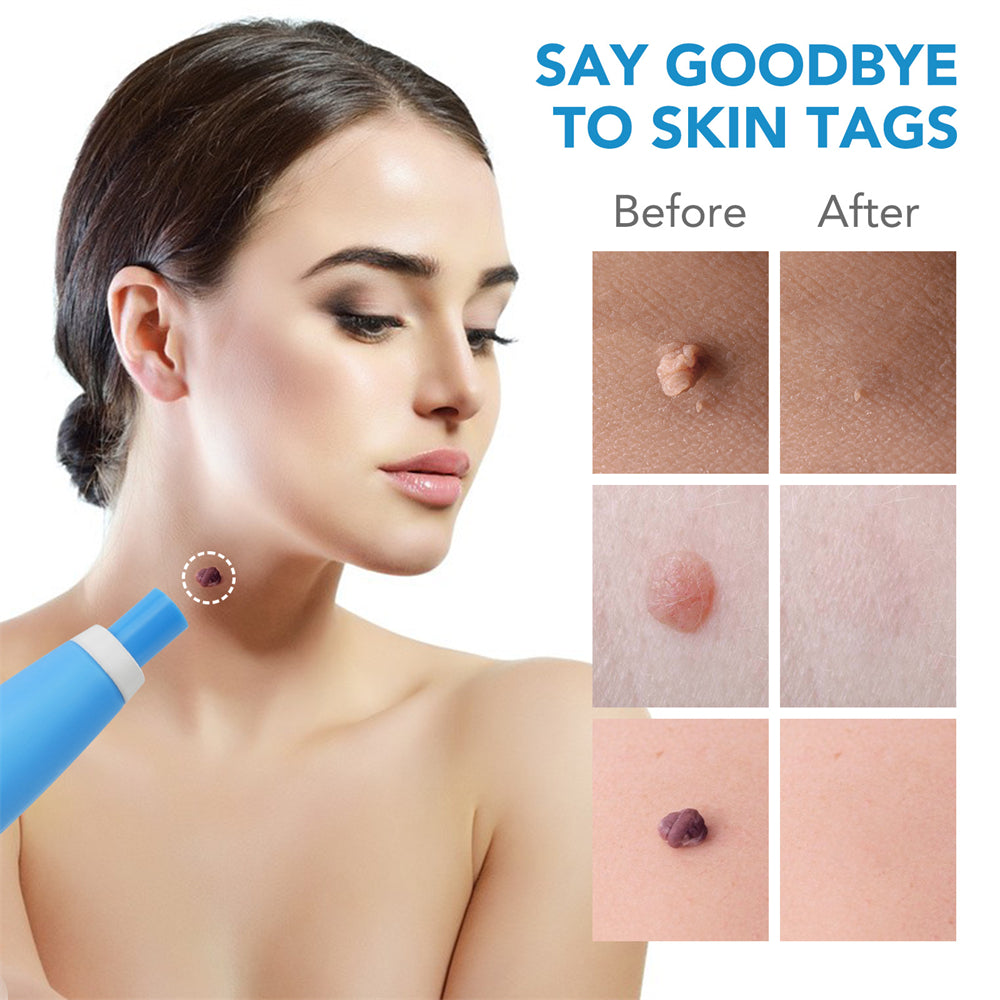 Dermoclear – Skin Tag & Wart Remover for Painless At-Home Treatment