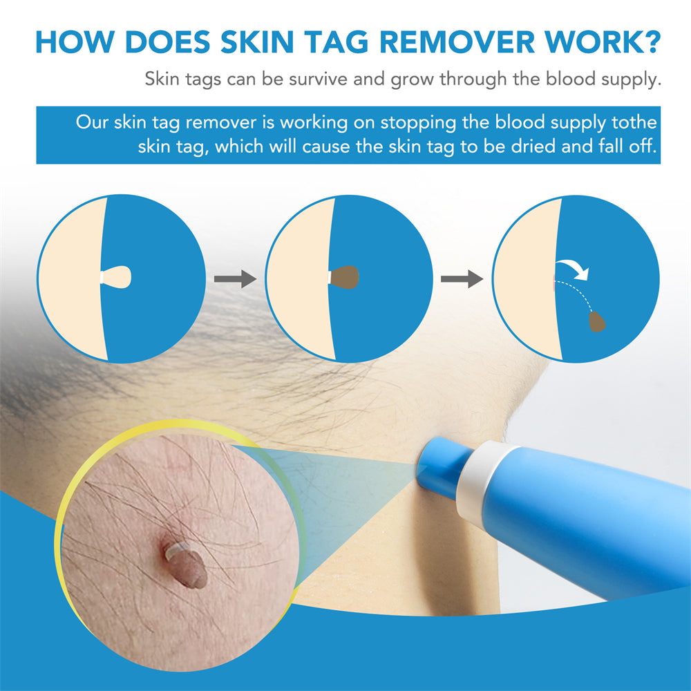 Dermoclear – Skin Tag & Wart Remover for Painless At-Home Treatment