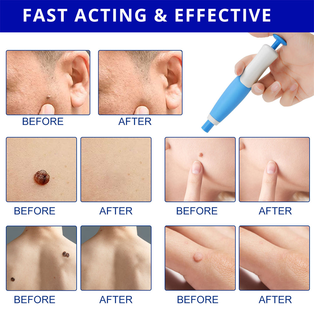 Dermoclear – Skin Tag & Wart Remover for Painless At-Home Treatment
