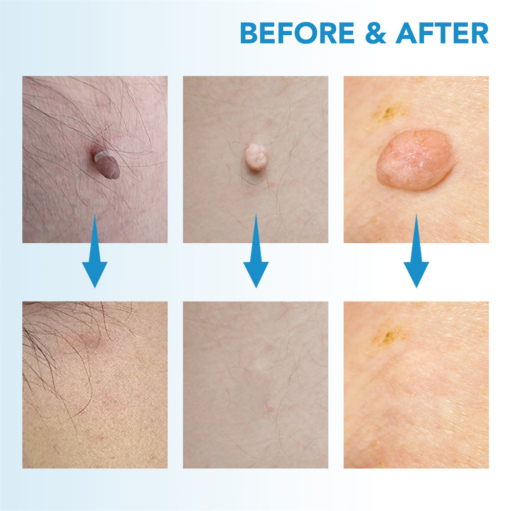 Dermoclear – Skin Tag & Wart Remover for Painless At-Home Treatment