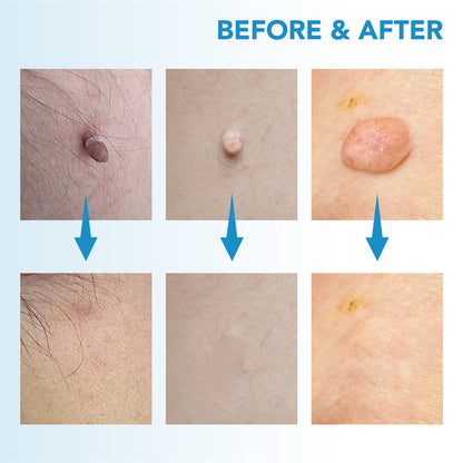 Dermoclear – Skin Tag & Wart Remover for Painless At-Home Treatment