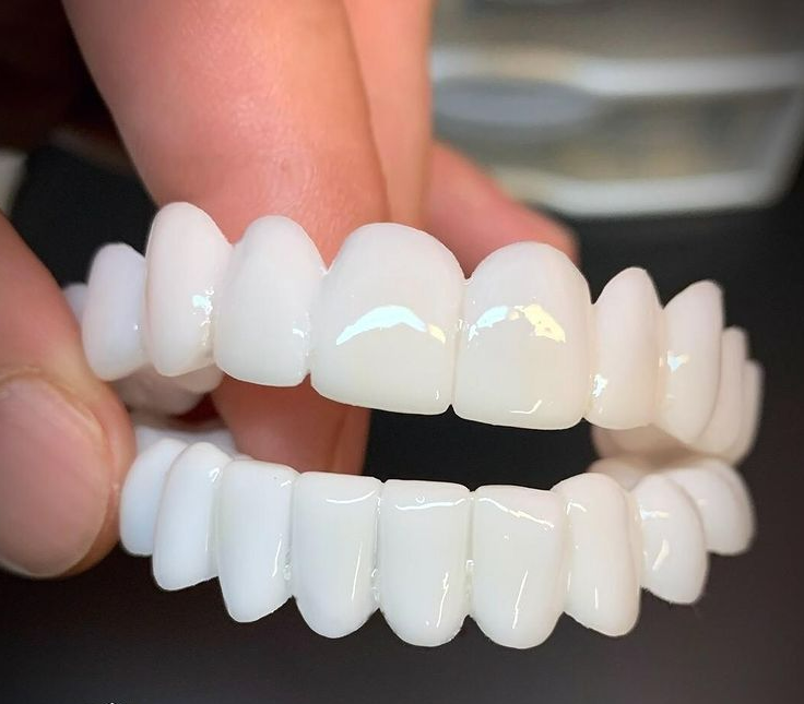 SmileFlex - prótesis con lentes dentales blancas