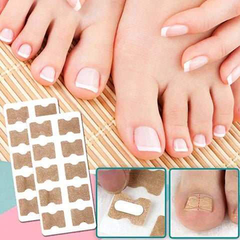 ALIGNSTRIP – Bandes Correctrices Indolores pour Ongles Incarnés et Déformés