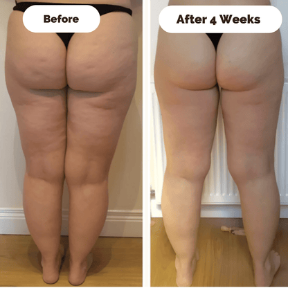 DERMAGLOW – Skin-Firming Massage Device for Cellulite