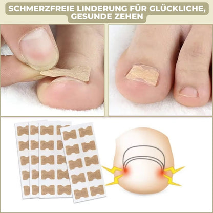 Fixerail - gentle nail correction against ingrown nails & pain 2