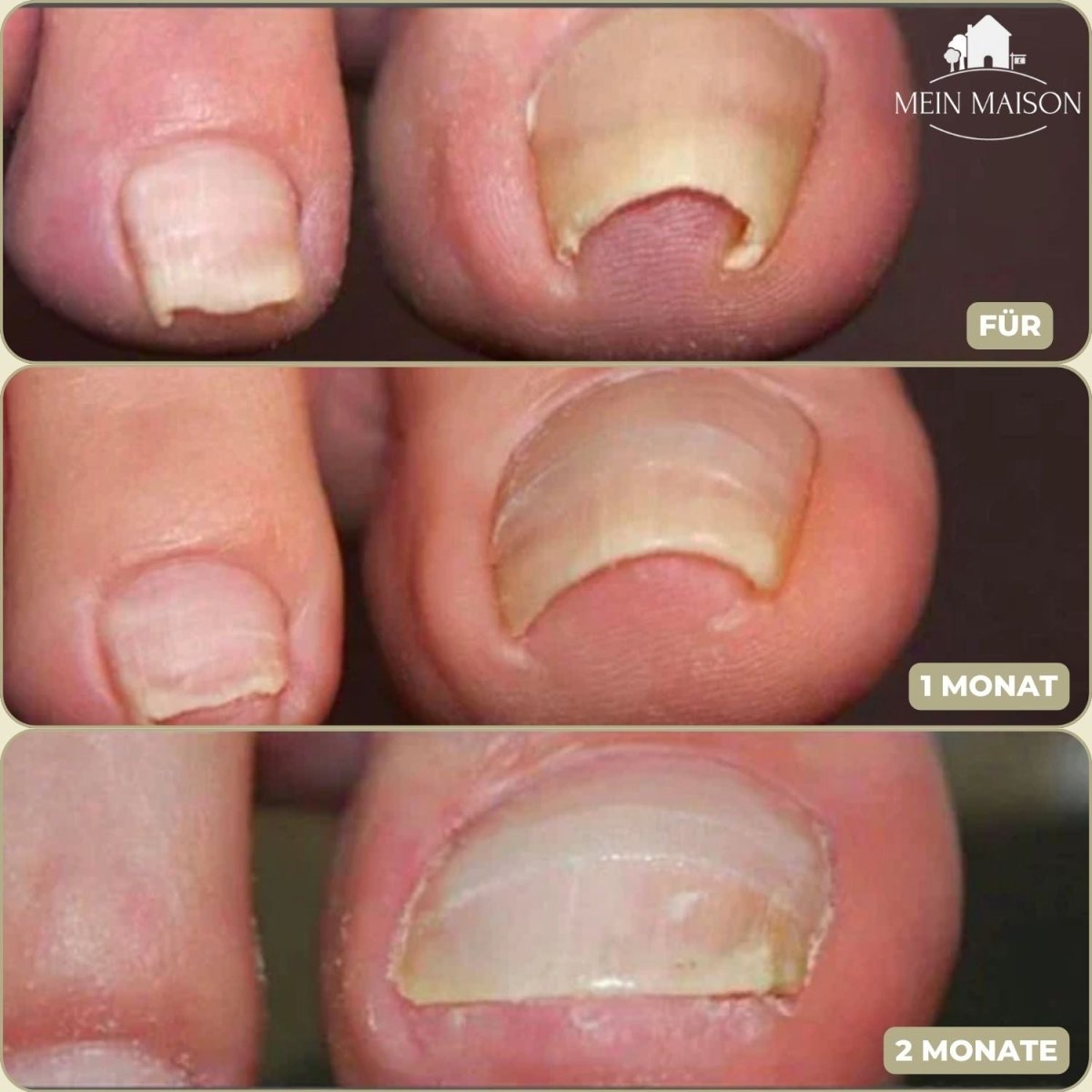 Fixerail - gentle nail correction against ingrown nails & pain 3