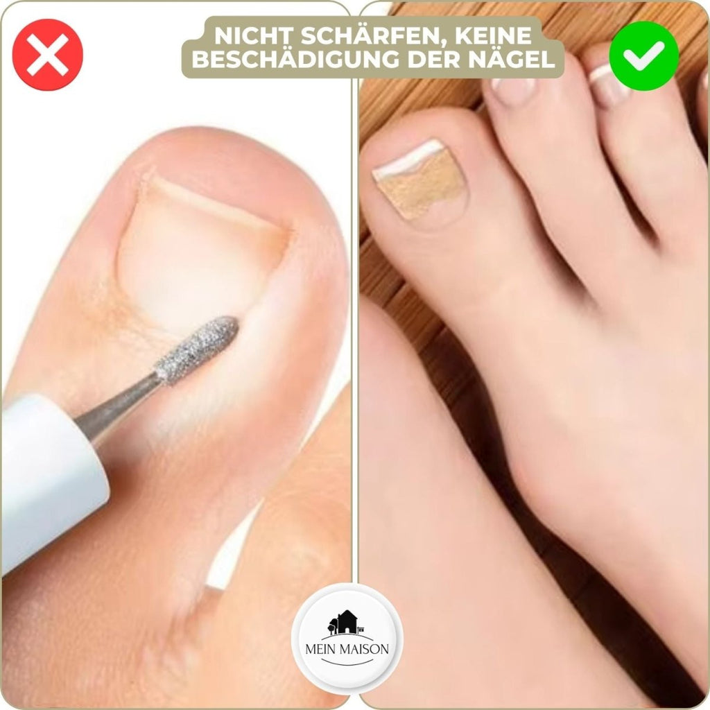 Fixerail - gentle nail correction against ingrown nails & pain 4